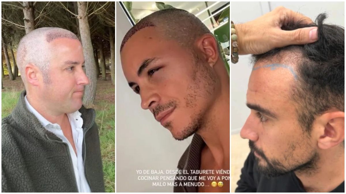 Las operaciones capilares y los famosos: IlloJuan y López Huerta ponen el pelo de moda