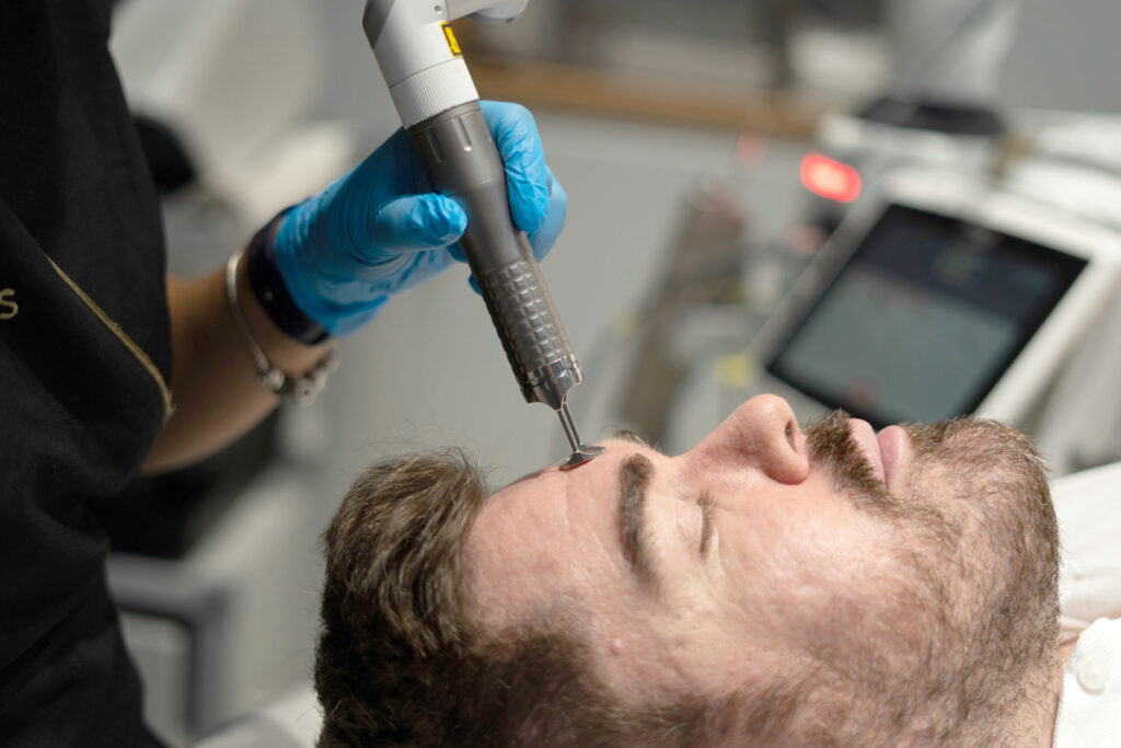 Tratamiento láser para las señales de acné. (Fuente: Clínica Benaes)