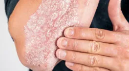 Takeda anuncia resultados positivos de zasocitinib en psoriasis en placas
