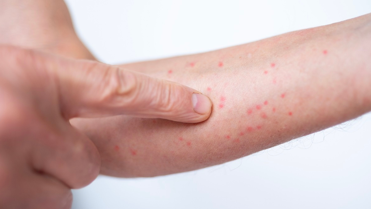 Un experto alerta de que la incidencia de la sarna se ha multiplicado por 50 en España