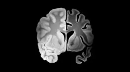 Un fármaco experimental logra frenar el alzhéimer antes de los síntomas