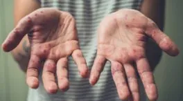 ¿Qué significa que España pierda el estatus de país libre de sarampión?