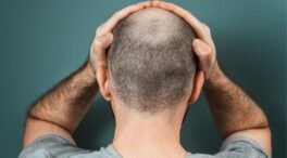 La terapia celular abre una nueva vía para acabar con la calvicie