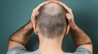 La terapia celular abre una nueva vía para acabar con la calvicie