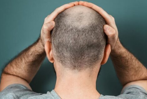 La terapia celular abre una nueva vía para acabar con la calvicie