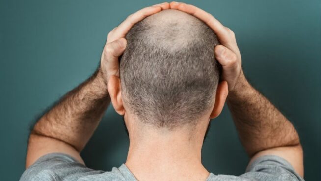 La terapia celular abre una nueva vía para acabar con la calvicie