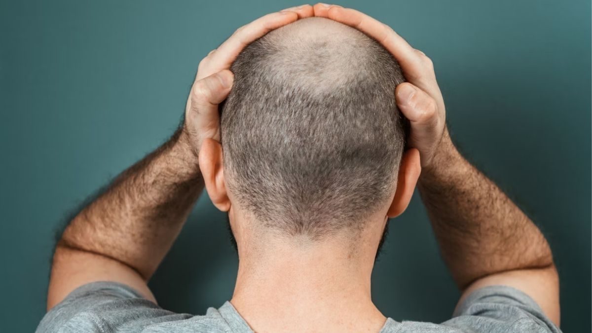 La terapia celular abre una nueva vía para acabar con la calvicie