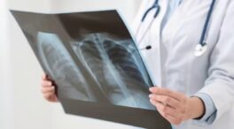 Millones de personas tienen la bacteria que causa la tuberculosis sin saberlo