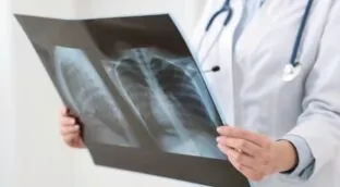 Millones de personas tienen la bacteria que causa la tuberculosis sin saberlo