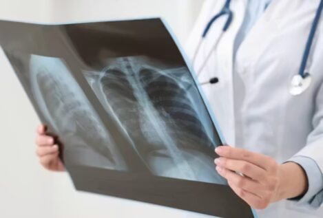 Millones de personas tienen la bacteria que causa la tuberculosis sin saberlo