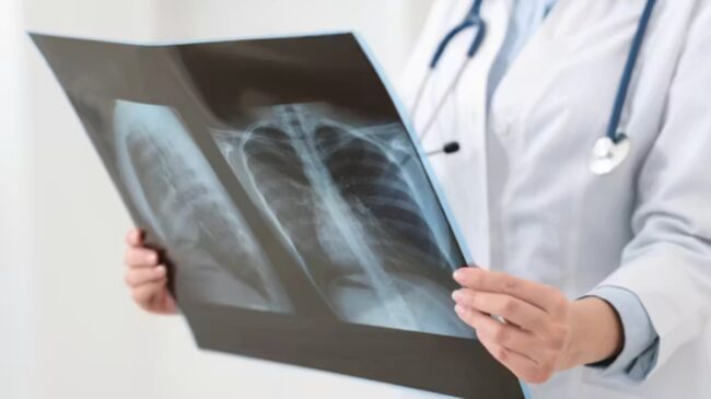 Millones de personas tienen la bacteria que causa la tuberculosis sin saberlo