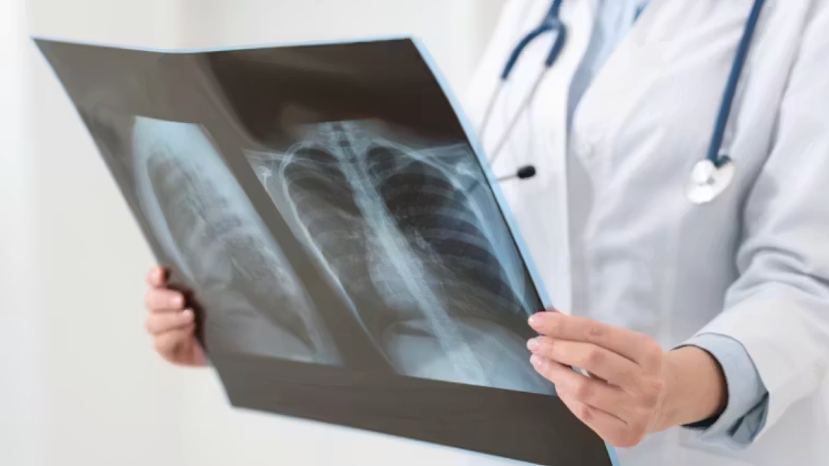 Millones de personas tienen la bacteria que causa la tuberculosis sin saberlo