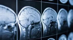 Un parche de seda podría ayudar al cerebro a recuperarse tras un ictus