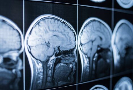 Un parche de seda podría ayudar al cerebro a recuperarse tras un ictus