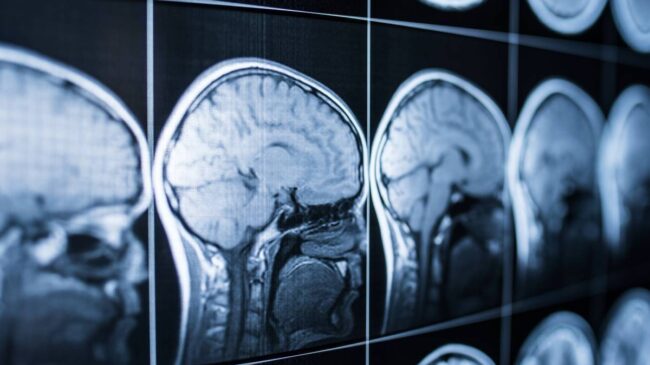 Un parche de seda podría ayudar al cerebro a recuperarse tras un ictus