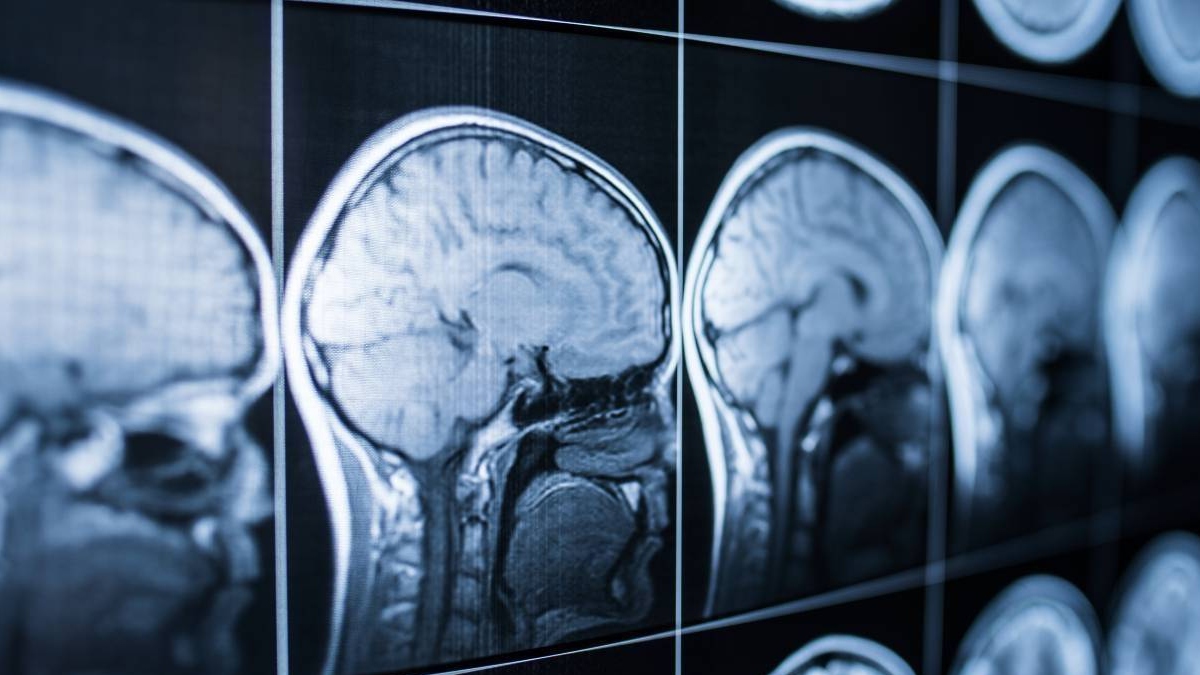 Un parche de seda podría ayudar al cerebro a recuperarse tras un ictus