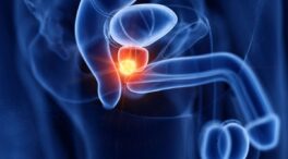 Nuevos datos respaldan la eficacia de la terapia con radioligandos en cáncer de próstata