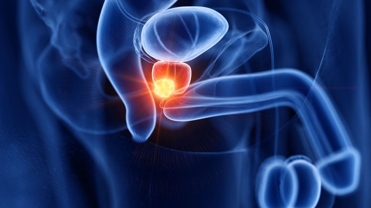 Nuevos datos respaldan la eficacia de la terapia con radioligandos en cáncer de próstata