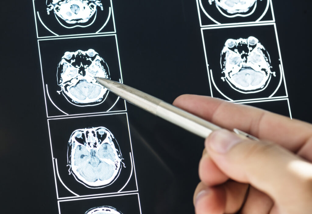 La ciencia lleva años demostrando que muchos de los hábitos cotidianos tienen un impacto directo en la salud cerebral